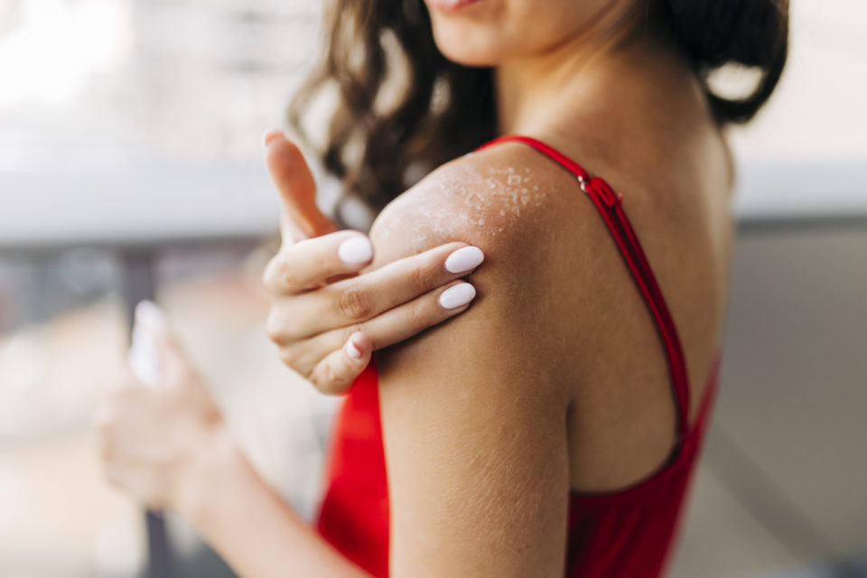 Close up of woman applying moisturizer on sunburned skin